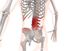 ぎっくり腰・急性腰痛は腰椎の問題が原因となっていることがあります