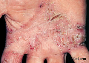eczéma chronique avec crevasses profondes 