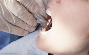 Professionelle Zahnreinigung: Schutz vor Karies, Parodontose und Mundgeruch