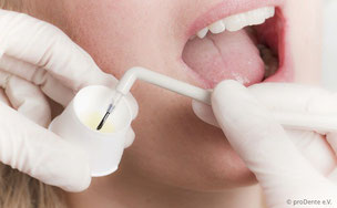Zur professionellen Zahnreinigung gehört auch die Härtung des Zahnschmelzes mit Fluoriden. (© proDente e.V.)