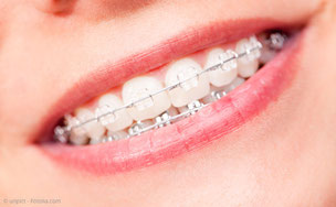 Bei fsetsitzenden KFO-Apparaturen ist die häusliche Mundpflege schwierig. Deshalb: Regelmäßige professionelle Zahnreinigungen! (© unpict - Fotolia.com)