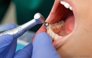 Damit sich nicht so schnell wieder Beläge festsetzen, werden die Zahnoberflächen poliert. (© okskaymark - Fotolia.com)