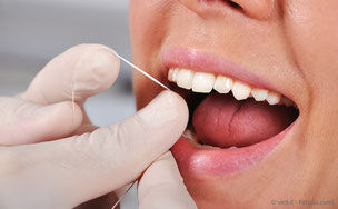 Auch die Zahnzwischenräume werden bei der PZR gründlich gereinigt. (© vetkit - Fotolia.com)