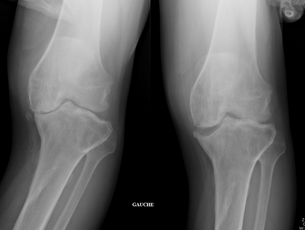 knee prothesis orthopaedic surgeon Dr Rémi Toulouse Croix du Sud