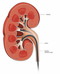 Calcul Renal Docteur Wassim Chaabane Urologue Centre Urbain Nord Tunis