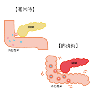 膵炎