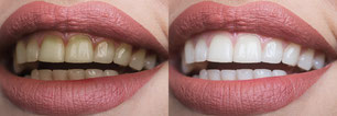 Vorher-Nachher-Vergleich: Zahnbleaching Ergebnisse