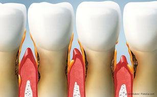 Parodontose: Was kann man gegen Zahnfleischentzündung und Zahnlockerungen tun?