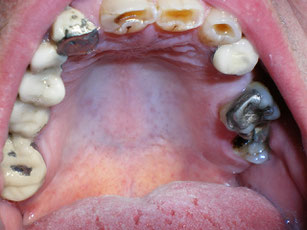teeth grinding down worn broken fork spanish porcelain