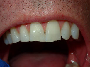 veneers and cosmetic dentist in Spanish Fork