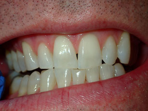 No room to lengthen the teeth.