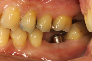 インプラントの上に入れる歯
