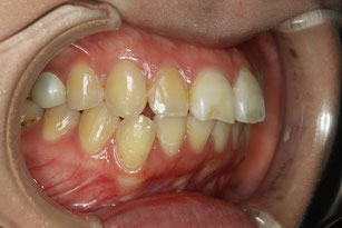 前歯２本の出っ歯