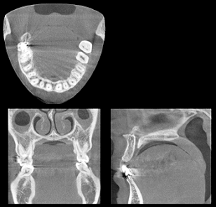 歯科用ＣＴ2