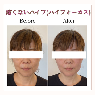 リフトアップハイフ　ビフォーアフター