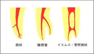 難しい根管・根管トラブル