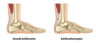 Achillessehnenruptur