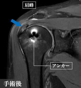 腱板断裂、千葉県、柏市、國府幸洋、名戸ヶ谷病院、整形外科、肩が痛い、関節治療センター、手術後、アンカー、bridging suture法、フットプリント