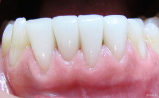 Veneers der unteren vier Schneidezähne bei einer Raucherin vier Jahre nach dem Einsetzen: Es sind keinerlei Verfärbungen sichtbar und das Zahnfleisch ist gesund.