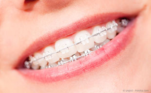Keramikbrackets Kunststoffbrackets