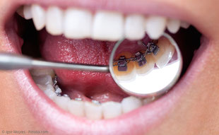 Zahnregulierung, die für andere kaum zu sehen ist.