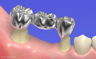 Implantat Siegen, Zahnarzt Dr. Motyka