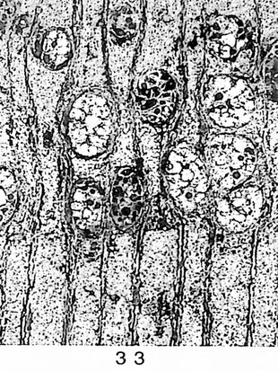 Fig. 33: Querschliff; locker ringporig mit sklerotischen Thyllen. Vertikales Parenchym vasizentrisch bis aliform.