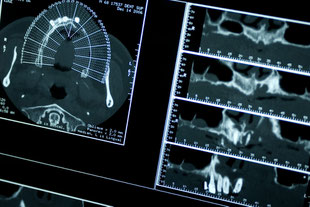 Implantatposition nach DVT-Auswertung