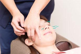 自費診療で顔の美容鍼をしている様子です。