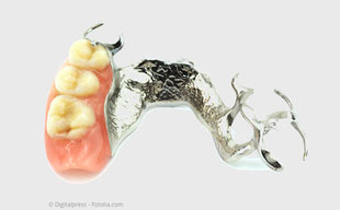 Mit Implantaten können sog. Teilprothesen oft vermieden werden.