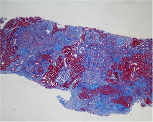 Muestra de tejido renal teñido con tricrómico de Masson.