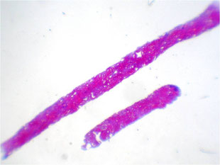Dos muestras de biopsia renal.