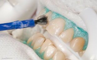 Weiße Zähne in ein bis zwei Stunden mit Power-Bleaching beim Zahnarzt!