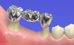 Für eine Brücke müssten oft gesunde Zähne abgeschliffen werden. Mit Implantaten kann man das vermeiden.