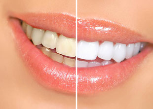 Deutlich sichtbar weißere Zähne mit Bleaching (Zahnaufhellung) beim Zahnarzt.