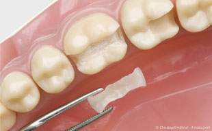 Hochwertige Keramik-Füllung (Inlay), die in einem Stück in den Zahn eingesetzt wird.