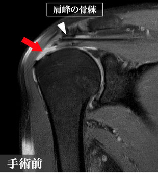 腱板断裂、千葉県、柏市、國府幸洋、名戸ヶ谷病院、整形外科、肩が痛い、関節治療センター、手術前