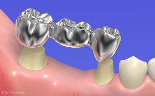 Zahnbrücke: Die Nachbarzähne der Lücke müssen für Kronen beschliffen werden.