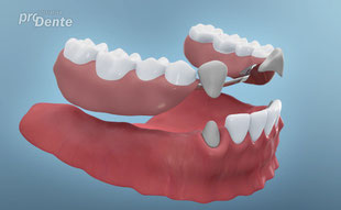Wenn im hinteren Kieferbereich Implantate mit Brücken gemacht werden, können Teilprothesen vermieden werden.