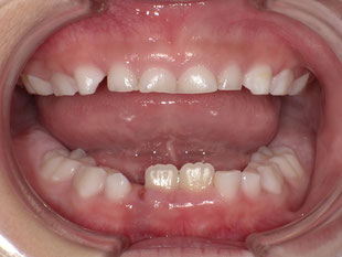 右下の乳歯を1本、抜歯