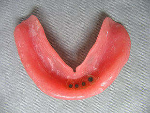 総義歯（磁石を応用）