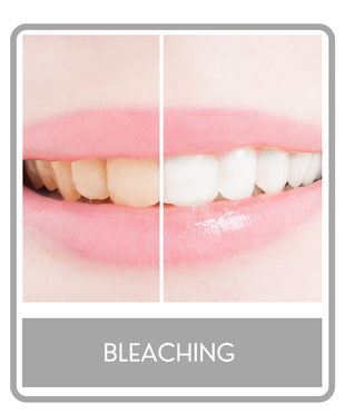 Bleaching Zahnarzt Erding