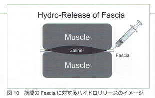 筋間のFasciaに対するハイドロリリース