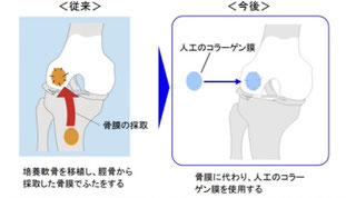 自家培養軟骨移植　低侵襲　人工コラーゲン膜　名戸ヶ谷病院　関節治療センター