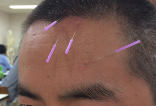 松木鍼灸院では、YNSA療法（山元式新頭鍼療法）という手技を用いています。
