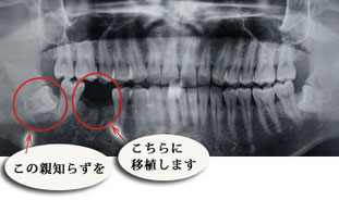 自家歯牙移植１