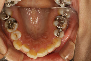 治療前　上の歯