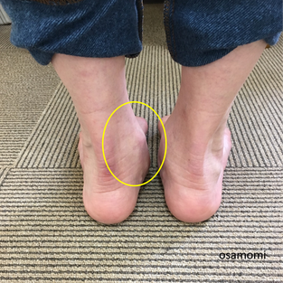 が 側面 足 痛い の