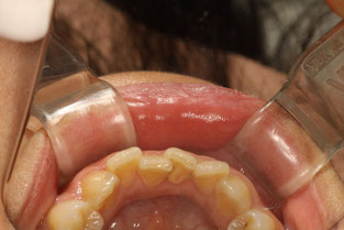 治療前　下の歯