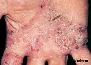 eczema chronique crevasse